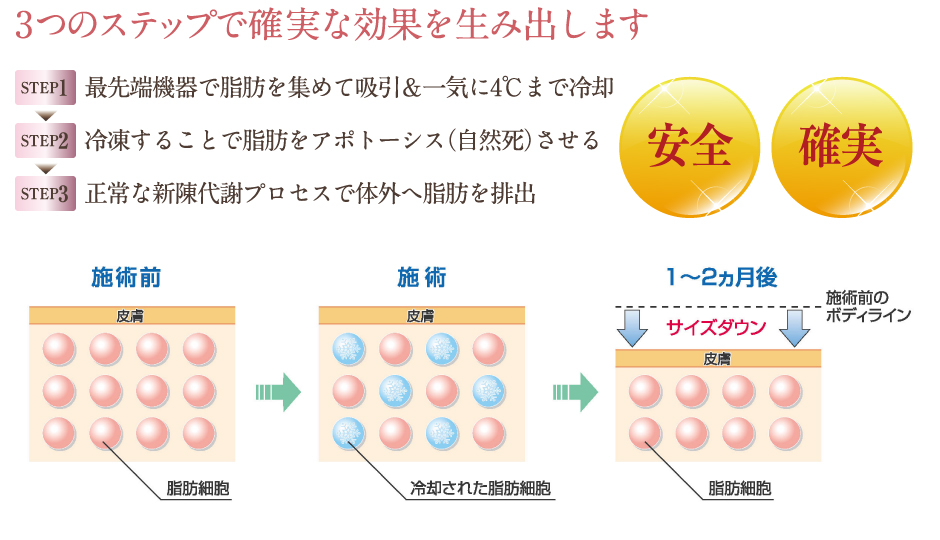 3つのステップで確実な効果を生み出します「最先端機器で脂肪を集めて吸引＆一気に4℃まで冷却。冷凍することで脂肪をアポトーシス（自然死）させる。正常な新陳代謝プロセスで体外へ脂肪を排出」