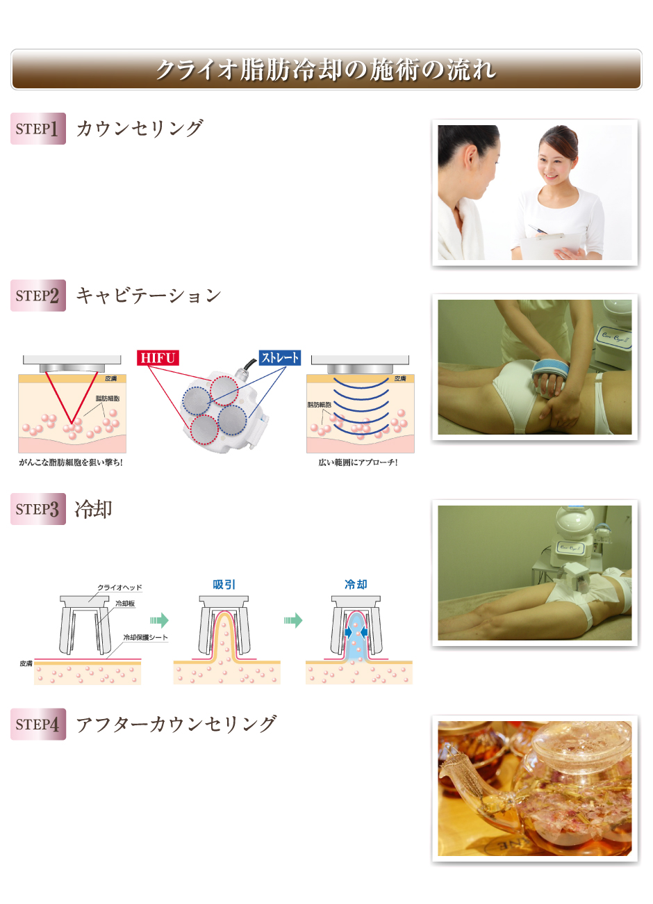 クライオ脂肪冷却の施術の流れ「カウンセリング。キャビテーション。冷却。アフターカウンセリング」